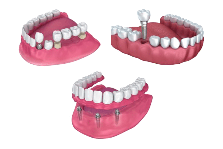 Implants are a permanent solution