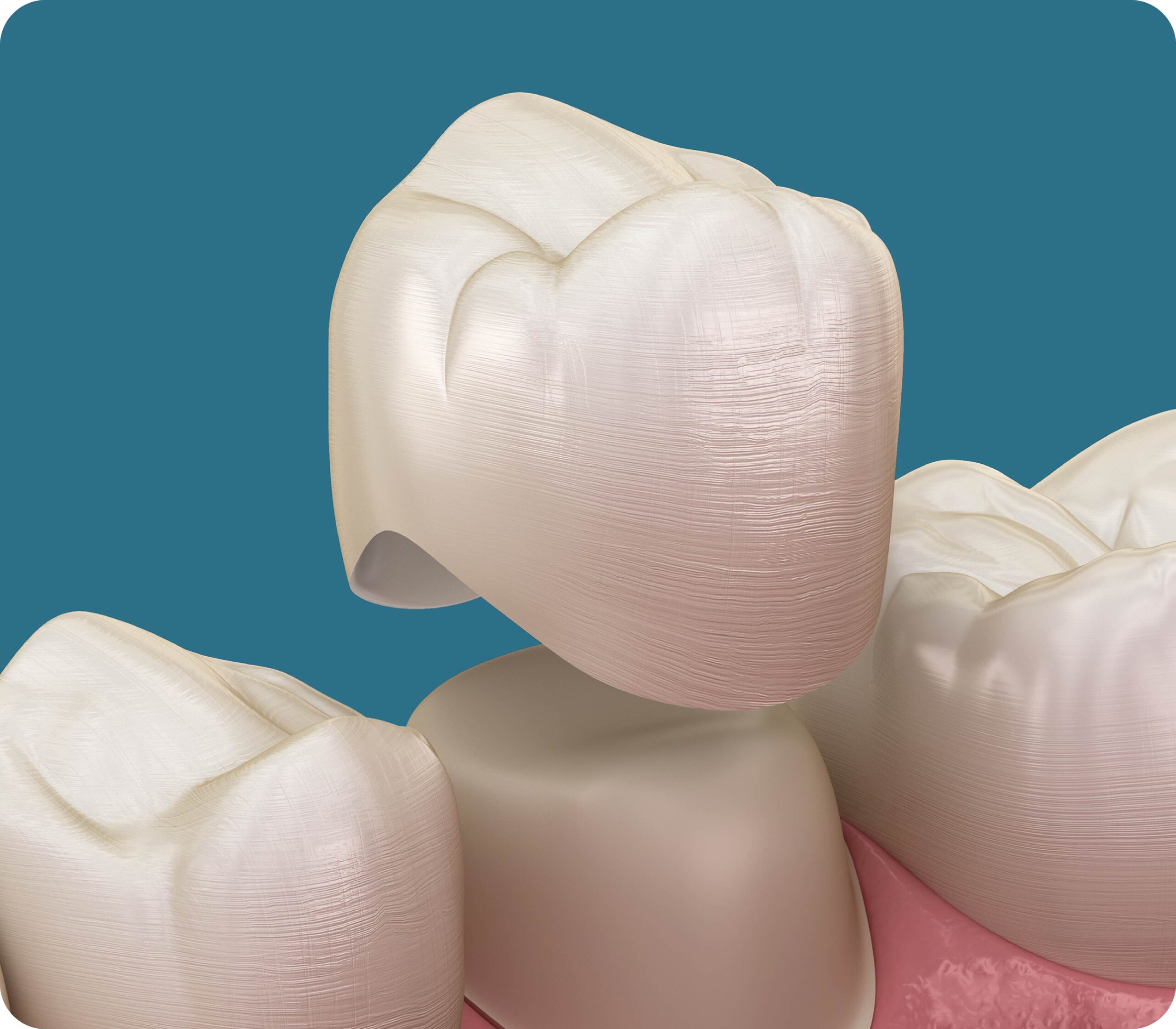 Restoring Teeth in a Single Visit 