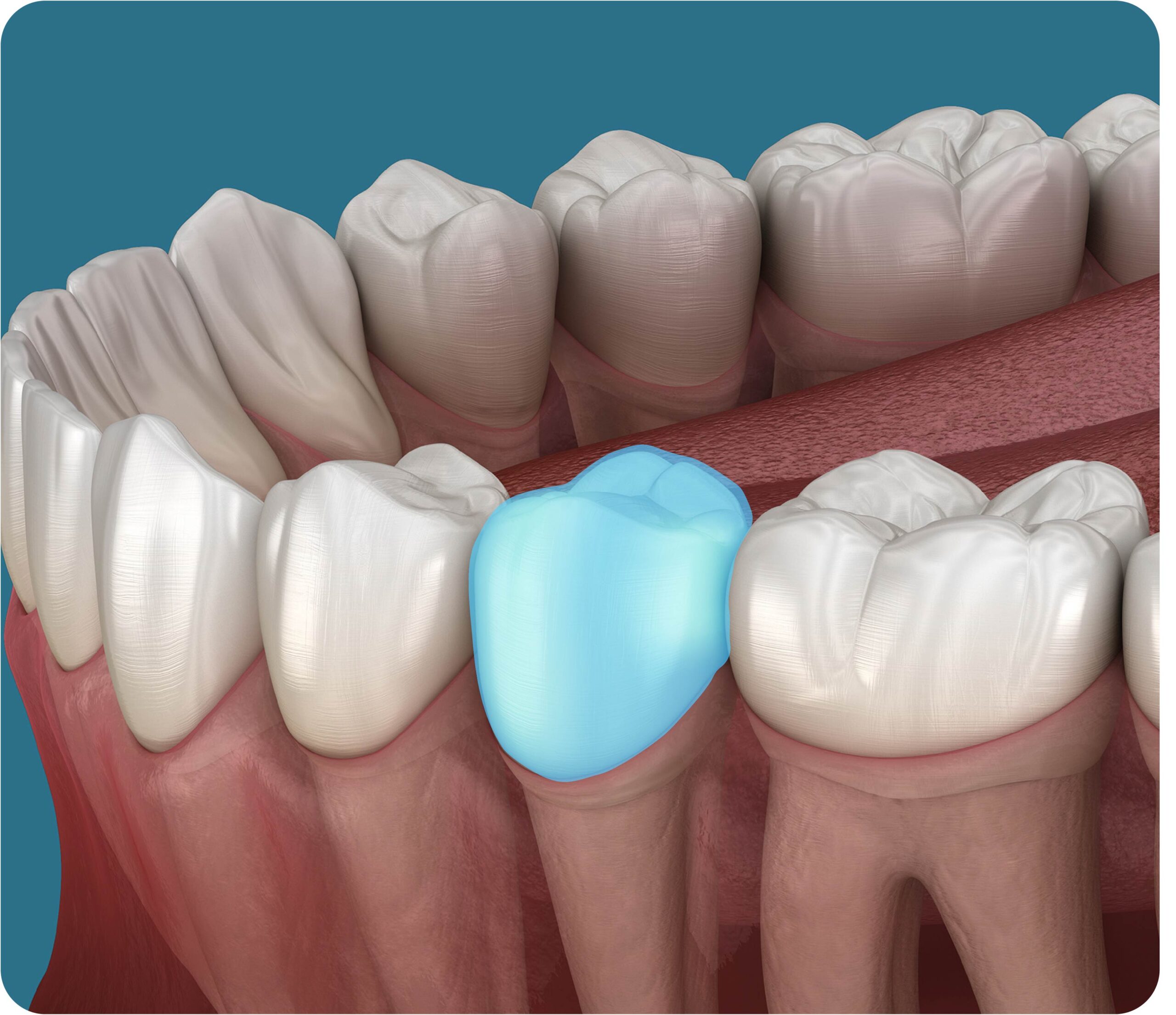 Treating Early Tooth Decay Without Drilling 