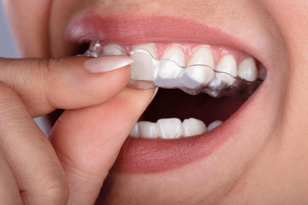 What are Clear Aligners?